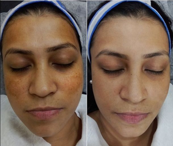Skin Glow Injection Before and After Results