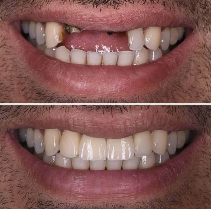 Dental Implants Before and After Results