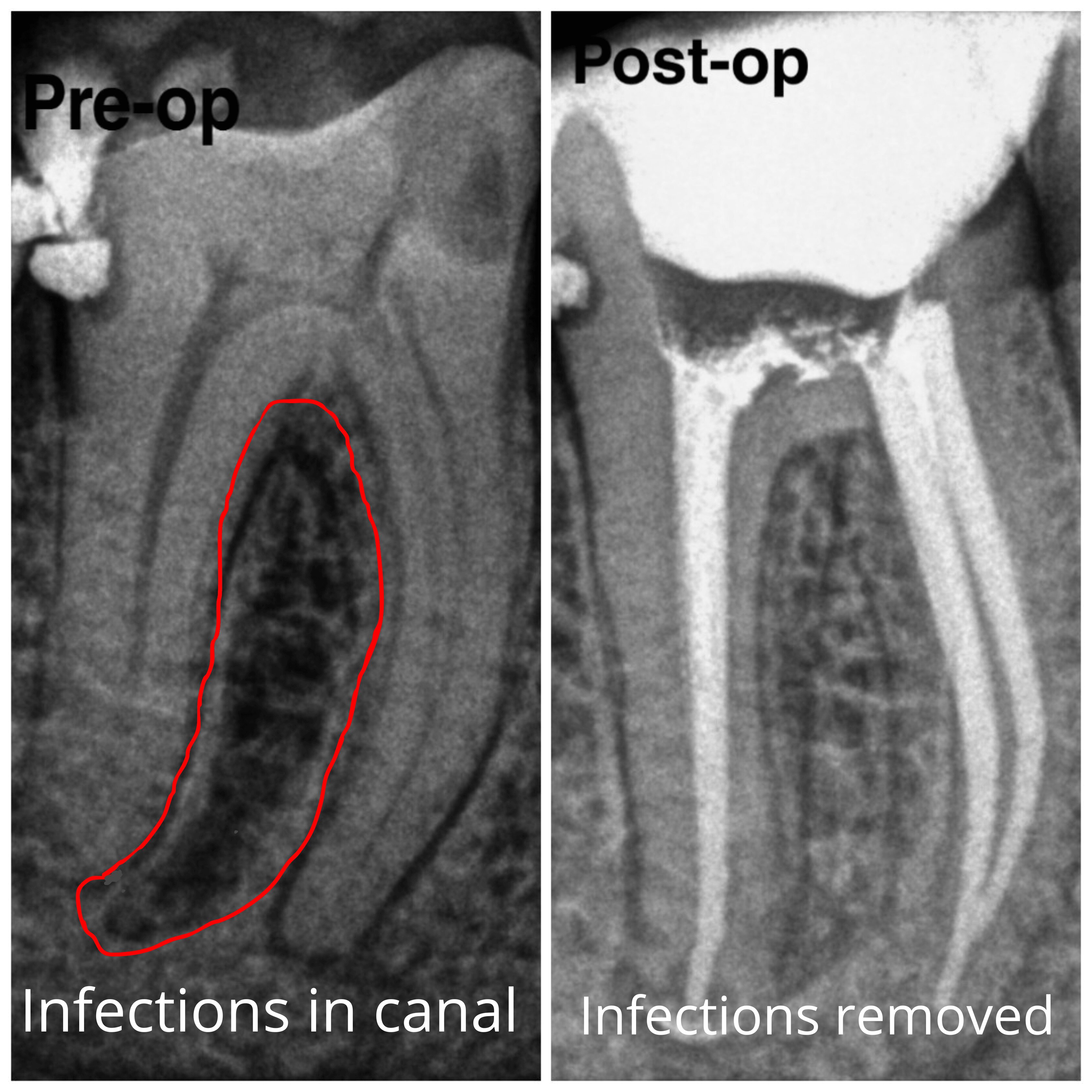 Root Canal Treatment Before and After Results